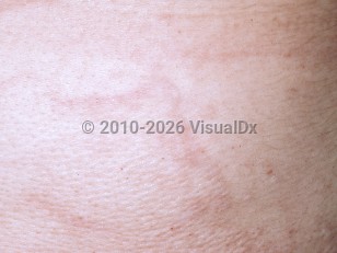 Clinical image of Mid-dermal elastolysis - imageId=4773381. Click to open in gallery.  caption: 'A close-up of subtly pink plaques with a peau d'orange appearance.'
