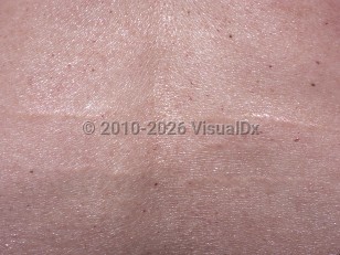 Clinical image of Linear focal elastosis - imageId=4790796. Click to open in gallery.  caption: 'A close-up of linear, yellow, striae-like plaques on the back.'