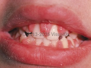 Clinical image of Gingival enlargement - imageId=5007. Click to open in gallery.  caption: 'Hypertrophy of gums with overlapping of the teeth.'