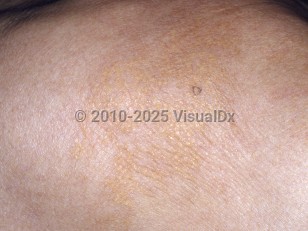 Clinical image of Plane xanthomas - imageId=5080420. Click to open in gallery.  caption: 'A close-up of confluent yellowish papules forming plaques.'