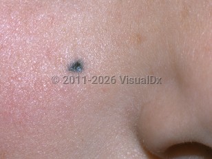 Clinical image of Traumatic tattoo - imageId=5269946. Click to open in gallery.  caption: 'A bluish-black papule on the cheek.'