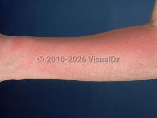 Clinical image of Sunburn - imageId=556579. Click to open in gallery.  caption: 'Bright pink erythema on the forearm.'
