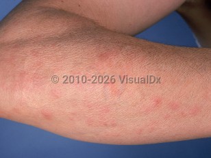 Clinical image of Autoimmune progesterone dermatitis - imageId=595447. Click to open in gallery.  caption: 'Faint erythematous papules and plaques on the forearm.'