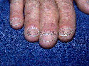 Thoracic outlet syndrome