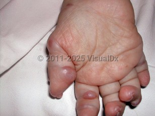 Clinical image of Hyaline fibromatosis syndrome - imageId=6022208. Click to open in gallery.  caption: 'Shiny reddish and somewhat translucent papules and nodules over the finger joints.'
