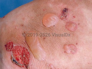 Clinical image of Epidermolysis bullosa acquisita - imageId=603509. Click to open in gallery.  caption: 'A close-up of tense and flaccid vesicles and bullae, and some crusts, on a background of pink erythema and light brown post-inflammatory patches.'