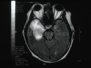 Imaging Studies image of Herpes simplex virus encephalitis - imageId=6173583. Click to open in gallery. 