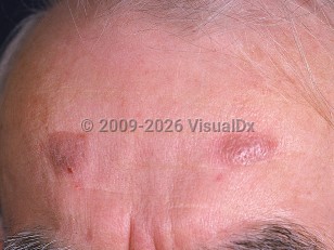 Clinical image of Granuloma faciale - imageId=631808. Click to open in gallery.  caption: 'A pink plaque with a peau d'orange appearance and another plaque with a pinkish-brown hue on the forehead.'