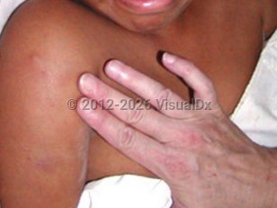 Clinical image of Pyomyositis - imageId=6431587. Click to open in gallery.  caption: 'Palpation reveals a "woody" texture of the involved muscle group. Note also the subtle patchy, violaceous hue of the affected area.'