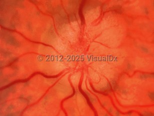 Ophthalmic Imaging image of Idiopathic intracranial hypertension - imageId=6552628. Click to open in gallery. 