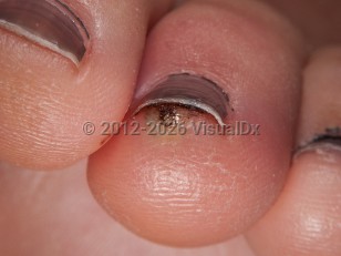 Clinical image of Tungiasis - imageId=6560910. Click to open in gallery.  caption: 'A cloudy vesicle with a central blackish crust on the distal toe.'