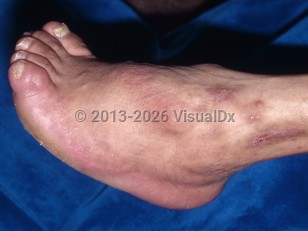 Clinical image of Poliomyelitis - imageId=6631792. Click to open in gallery.  caption: 'A high arched left foot with an inturned heel.'