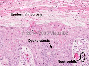 Lab image of Necrolytic acral erythema - imageId=6818816. Click to open in gallery. 