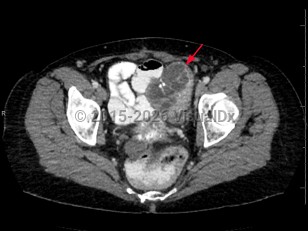 Imaging Studies image of Ovarian cancer - imageId=6846725. Click to open in gallery.  caption: '<span>Axial CT image demonstrates a  large, heterogeneous, partially solid, and cystic mass involving the left  adnexa. Biopsy results were consistent with ovarian carcinoma.</span>'