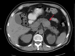 Pancreatic carcinoma