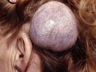 Clinical image of Meningioma - imageId=6858743. Click to open in gallery.  caption: 'A smooth, pink and violaceous tumor with overlying telangiectasias on the postauricular scalp.'