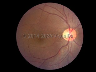 Ophthalmic Imaging image of Macular pucker - imageId=7171019. Click to open in gallery. 