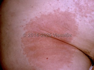 Clinical image of CS tear gas intoxication - imageId=7416779. Click to open in gallery.  caption: 'Thin erythematous papules and plaques on the lower abdomen and thigh.'