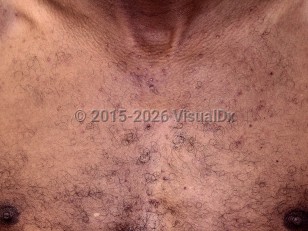 Clinical image of Cutaneous adverse effects of EGFR inhibitors - imageId=7757239. Click to open in gallery.  caption: 'Scattered acneiform papules and tiny pustules on the chest of a patient on EGFR inhibitor therapy.<br/><br/>Image appears with permission from East Carolina University Division of Dermatology.'