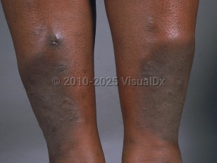 Clinical image of Pretibial myxedema - imageId=781247. Click to open in gallery.  caption: 'Bound-down dark brown plaques and similar nodules on the lower shins.'