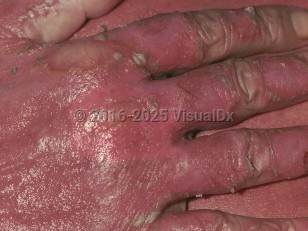 Erythrodermic psoriasis