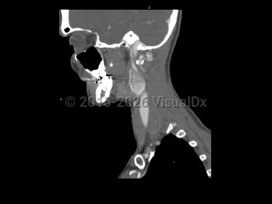 Imaging Studies image of Carotid body tumor - imageId=7872301. Click to open in gallery.  caption: '<span>Sagittal post-contrast CT image  demonstrates an enhancing mass in the carotid space, splaying the  internal and external carotid arteries. Findings are consistent with a  carotid body tumor.</span>'