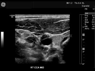 Imaging Studies image of Carotid artery dissection - imageId=7872495. Click to open in gallery.  caption: '<span>Common carotid artery dissection.   Grayscale ultrasound image demonstrates a luminal flap within the common  carotid artery. Dissection was confirmed by CT angiogram (not shown).</span>'