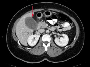 Imaging Studies image of Acute cholecystitis - imageId=7878656. Click to open in gallery.  caption: '<span>CT scan of the abdomen demonstrating distended gallbladder with wall thickening and inflammatory changes in the surrounding fat.</span>'