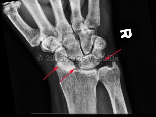 Imaging Studies image of Calcium pyrophosphate deposition disease - imageId=7889984. Click to open in gallery.  caption: '<span>CPPD of the wrist with  chondrocalcinosis of the TFCC and scapholunate ligaments. Note the  pronounced radiocarpal joint space narrowing at the radioscaphoid joint  with a stepladder appearance of the scaphoid to lunate transition which  is a finding compatible with CPPD arthropathy.</span>'