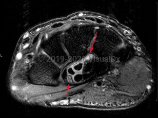 Imaging Studies image of Carpal tunnel syndrome - imageId=7899721. Click to open in gallery.  caption: '<span>Axial intermediate weighted  MRI sequence demonstrates inflammation surrounding the flexor tendons  within the carpal tunnel, with edema of the median nerve (shorter arrow). &nbsp;Compatible with carpal tunnel syndrome.</span>'