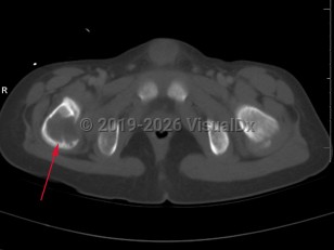 Imaging Studies image of Eosinophilic granuloma of bone - imageId=8322100. Click to open in gallery.  caption: '<span>Axial CT of the pelvis  demonstrates a large lytic lesion involving the right hip with cortical  destruction. This pediatric patient also had multiple other sites of  lytic lesions, including the skull. Given the constellation of findings,  this is most compatible with an eosinophilic granuloma.</span>'
