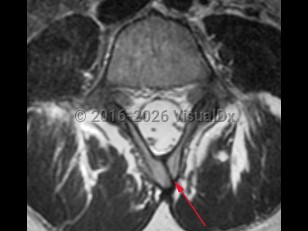 Imaging Studies image of Spina bifida - imageId=8343872. Click to open in gallery.  caption: '<span>Axial MRI demonstrating bony defect in vertebral arch.</span>'