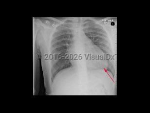 Hypertrophic cardiomyopathy