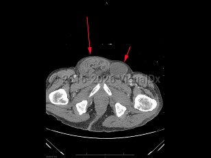 Imaging Studies image of Inguinal hernia - imageId=8359347. Click to open in gallery.  caption: '<span>Axial image from unenhanced CT scan of the pelvis demonstrates a large right inguinal hernia containing loops of non-obstructed bowel (large arrow). There is also a smaller left inguinal hernia containing fluid on the left (small arrow).</span>'