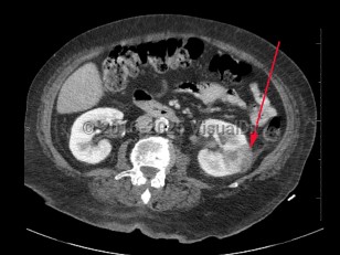 Pyelonephritis