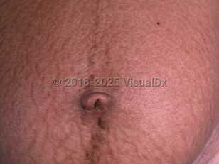 Clinical image of Striae - imageId=848847. Click to open in gallery.  caption: 'Multiple brown, curvilinear and linear, atrophic plaques with a rippled appearance on the abdomen of a pregnant patient.'