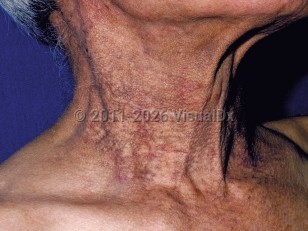 Clinical image of Pigmented contact dermatitis - imageId=93789. Click to open in gallery.  caption: 'Hyperpigmented and reddish patches on the neck.'