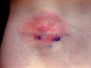 Clinical image of Fibrosarcoma - imageId=984128. Click to open in gallery.  caption: 'A pink plaque studded with pink papules and nodules on the back.'