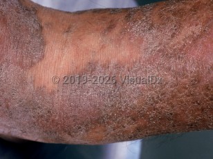 Clinical image of Non-AIDS-associated Kaposi sarcoma - imageId=989053. Click to open in gallery.  caption: 'A close-up of extensive scaly, violaceous plaques.'